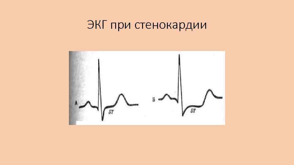 ЭКГ при стенокардии 
