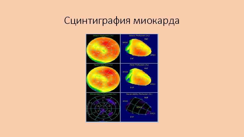 Сцинтиграфия миокарда 