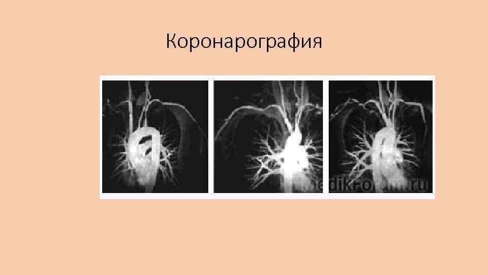 Коронарография 