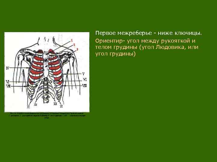 Первое межреберье - ниже ключицы. Ориентир- угол между рукояткой и телом грудины (угол Людовика,