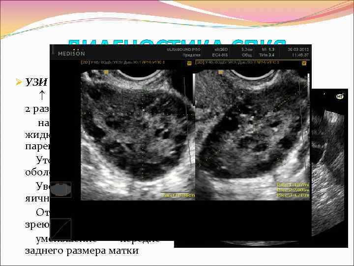 Диаметр яичника. УЗИ измерение яичников. Яичники на УЗИ норма. Объем яичника по УЗИ. Жидкостное образование на УЗИ.