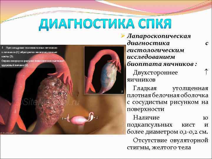 Ø Лапароскопическая диагностика с гистологическим исследованием биоптата яичников : Двухстороннее яичников Гладкая утолщенная плотная