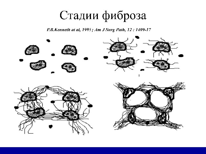Внутрипортальный Множество септ, деформация, мостовидные изменения Портальный, с редкими септами Цирроз 