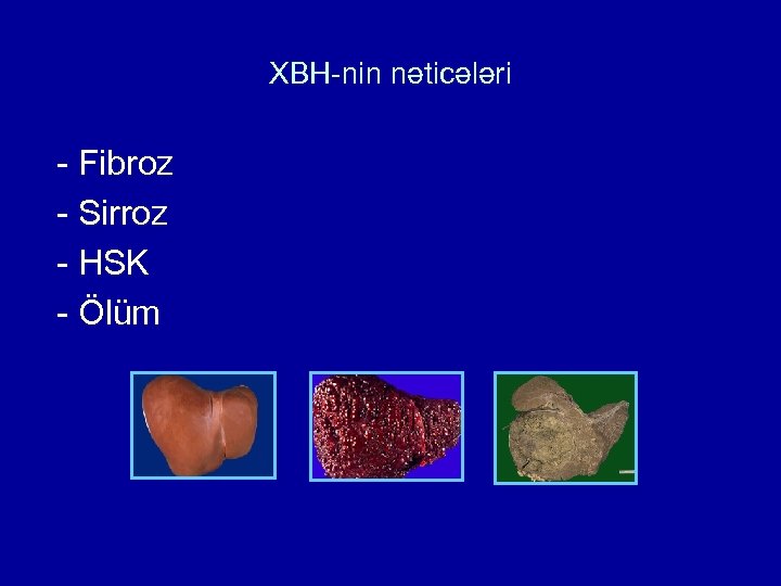 XBH-nin nəticələri - Fibroz - Sirroz - HSK - Ölüm Нормальная печень Цирроз ГЦК