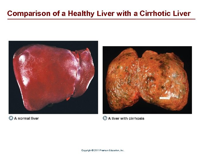 Comparison of a Healthy Liver with a Cirrhotic Liver Copyright © 2011 Pearson Education,