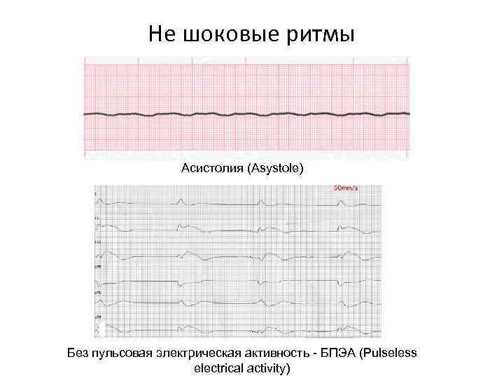 Не шоковые ритмы Асистолия (Asystole) Без пульсовая электрическая активность - БПЭА (Pulseless electrical activity)