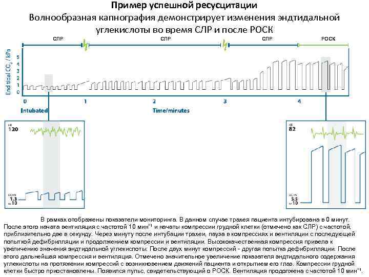 Пример успешной ресусцитации Волнообразная капнография демонстрирует изменения эндтидальной углекислоты во время СЛР и после
