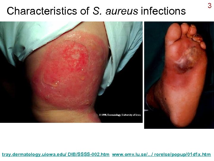 Characteristics of S. aureus infections 3 tray. dermatology. uiowa. edu/ DIB/SSSS-002. htm www. omv.