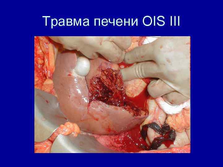 Травма печени OIS III 