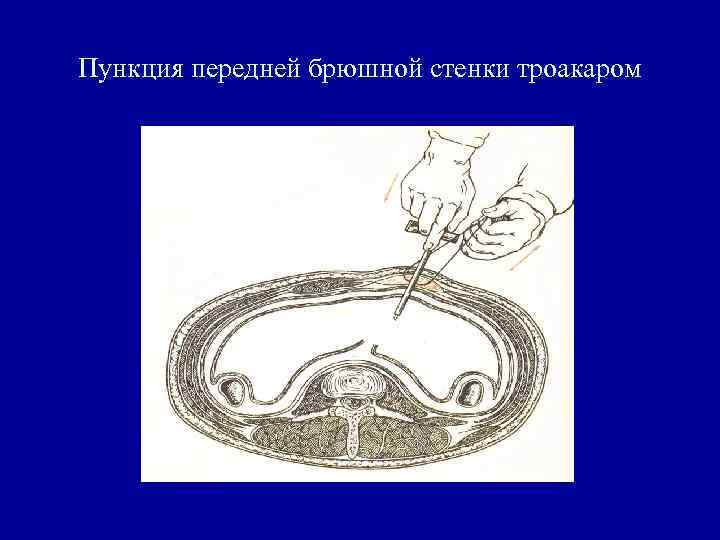 Пункция передней брюшной стенки троакаром 