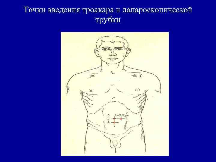 Точки введения троакара и лапароскопической трубки 