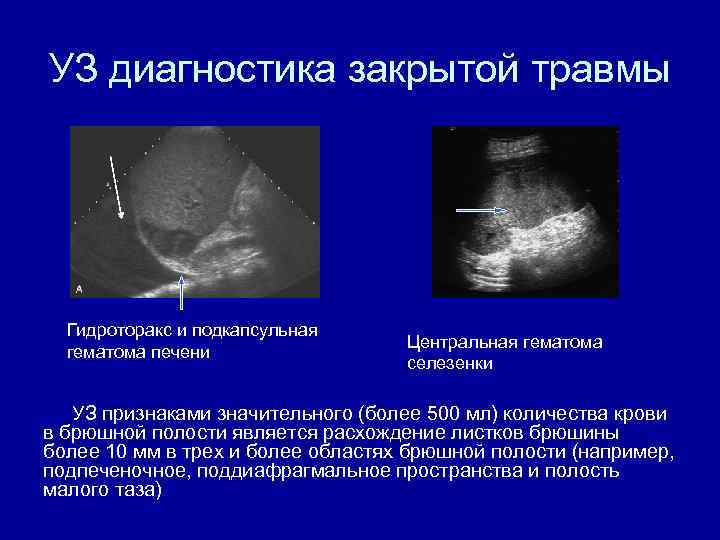 УЗ диагностика закрытой травмы Гидроторакс и подкапсульная гематома печени Центральная гематома селезенки УЗ признаками