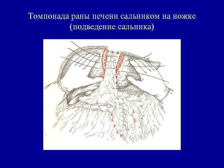 Томпонада раны печени сальником на ножке (подведение сальника) 