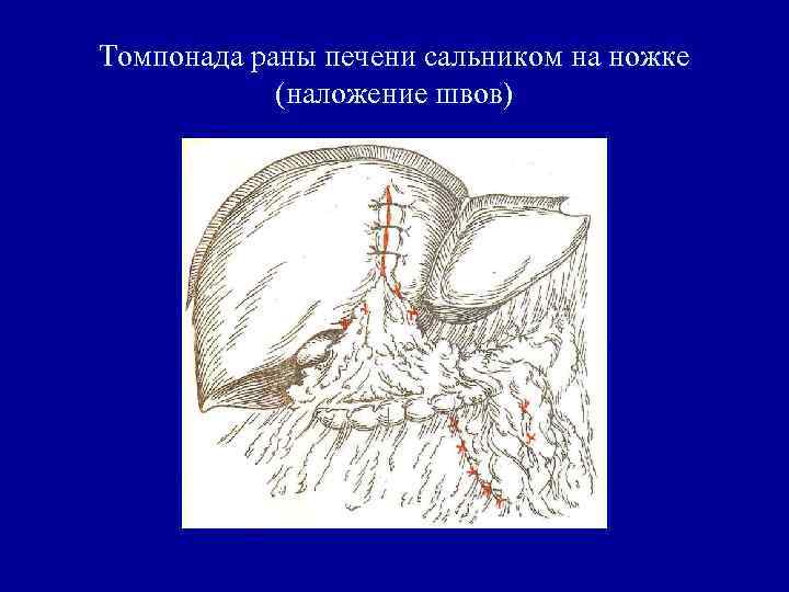 Томпонада раны печени сальником на ножке (наложение швов) 