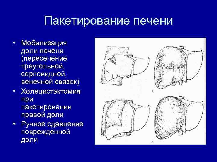 Пакетирование печени • Мобилизация доли печени (пересечение треугольной, серповидной, венечной связок) • Холецистэктомия при