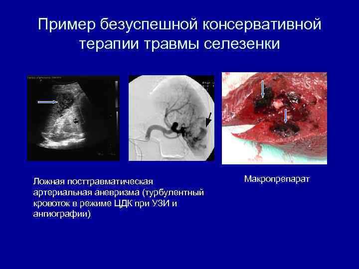 Пример безуспешной консервативной терапии травмы селезенки Ложная посттравматическая артериальная аневризма (турбулентный кровоток в режиме