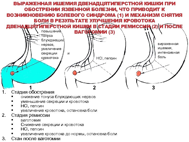 Ишемия кишки