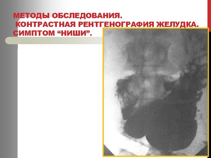 МЕТОДЫ ОБСЛЕДОВАНИЯ. КОНТРАСТНАЯ РЕНТГЕНОГРАФИЯ ЖЕЛУДКА. СИМПТОМ “НИШИ”. 