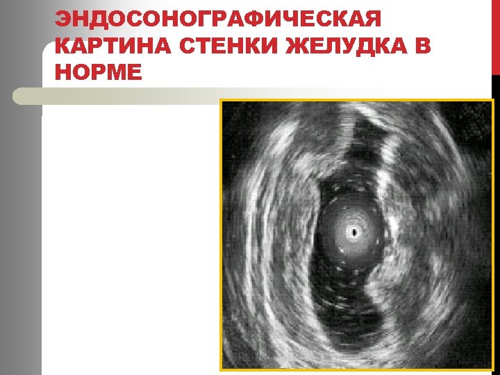 ЭНДОСОНОГРАФИЧЕСКАЯ КАРТИНА СТЕНКИ ЖЕЛУДКА В НОРМЕ 