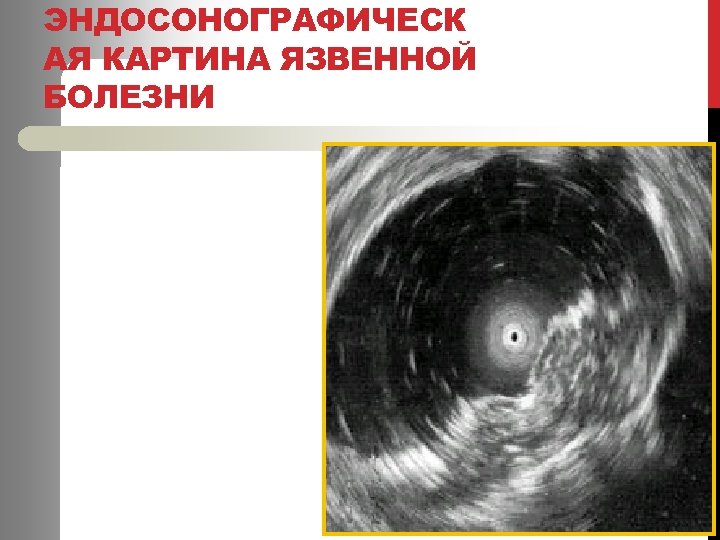 ЭНДОСОНОГРАФИЧЕСК АЯ КАРТИНА ЯЗВЕННОЙ БОЛЕЗНИ 