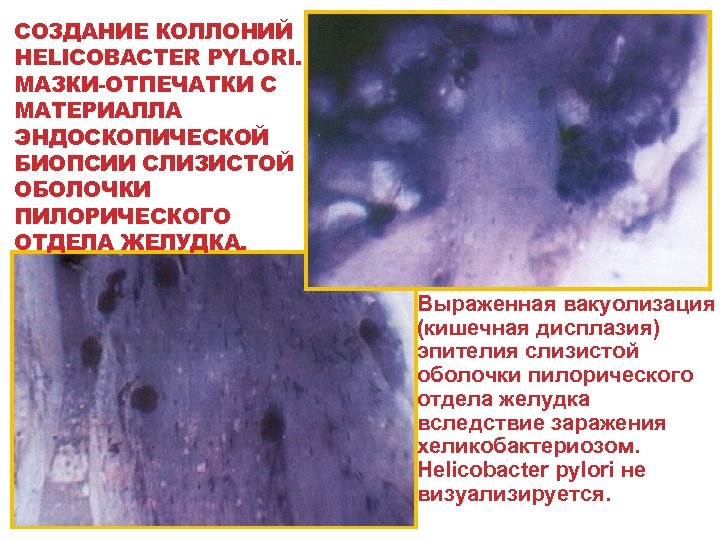 СОЗДАНИЕ КОЛЛОНИЙ HELICOBACTER PYLORI. МАЗКИ-ОТПЕЧАТКИ С МАТЕРИАЛЛА ЭНДОСКОПИЧЕСКОЙ БИОПСИИ СЛИЗИСТОЙ ОБОЛОЧКИ ПИЛОРИЧЕСКОГО ОТДЕЛА ЖЕЛУДКА.
