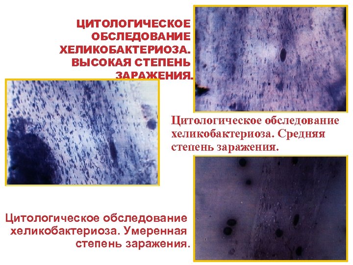 ЦИТОЛОГИЧЕСКОЕ ОБСЛЕДОВАНИЕ ХЕЛИКОБАКТЕРИОЗА. ВЫСОКАЯ СТЕПЕНЬ ЗАРАЖЕНИЯ. Цитологическое обследование хеликобактериоза. Средняя степень заражения. Цитологическое обследование