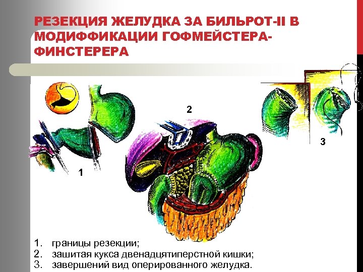 РЕЗЕКЦИЯ ЖЕЛУДКА ЗА БИЛЬРОТ-ІІ В МОДИФФИКАЦИИ ГОФМЕЙСТЕРАФИНСТЕРЕРА 2 3 1 1. границы резекции; 2.