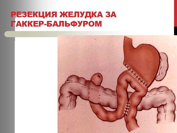 РЕЗЕКЦИЯ ЖЕЛУДКА ЗА ГАККЕР-БАЛЬФУРОМ 