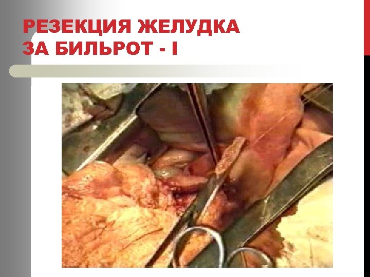 РЕЗЕКЦИЯ ЖЕЛУДКА ЗА БИЛЬРОТ - І 