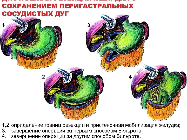 ДИСТАЛЬНАЯ РЕЗЕКЦИЯ ЖЕЛУДКА С СОХРАНЕНИЕМ ПЕРИГАСТРАЛЬНЫХ СОСУДИСТЫХ ДУГ 1 3 2 4 1, 2