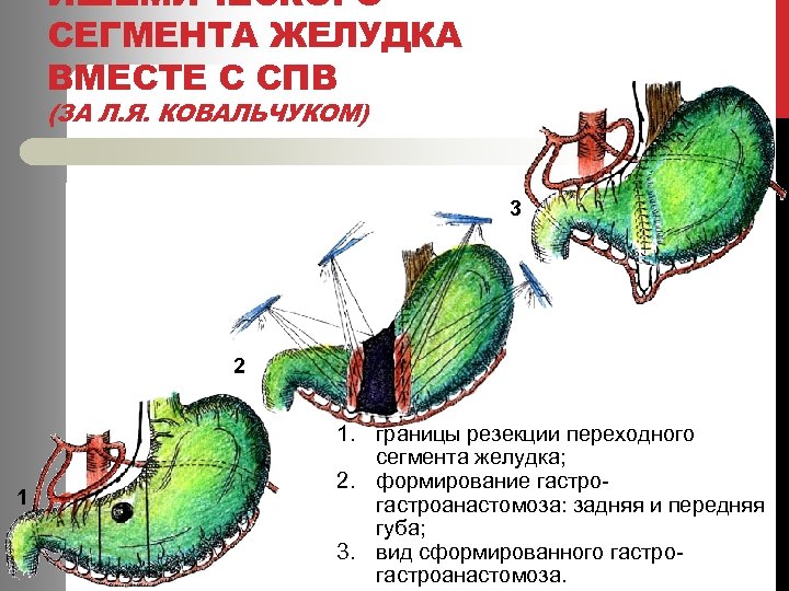 ИШЕМИЧЕСКОГО СЕГМЕНТА ЖЕЛУДКА ВМЕСТЕ С СПВ (ЗА Л. Я. КОВАЛЬЧУКОМ) 3 2 1 1.