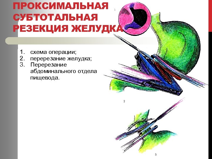 ПРОКСИМАЛЬНАЯ СУБТОТАЛЬНАЯ РЕЗЕКЦИЯ ЖЕЛУДКА 1. схема операции; 2. перерезание желудка; 3. Перерезание абдоминального отдела