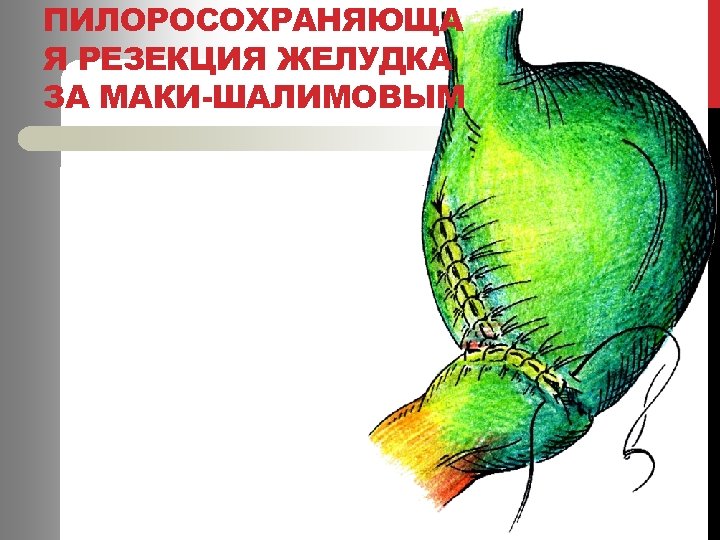 ПИЛОРОСОХРАНЯЮЩА Я РЕЗЕКЦИЯ ЖЕЛУДКА ЗА МАКИ-ШАЛИМОВЫМ 