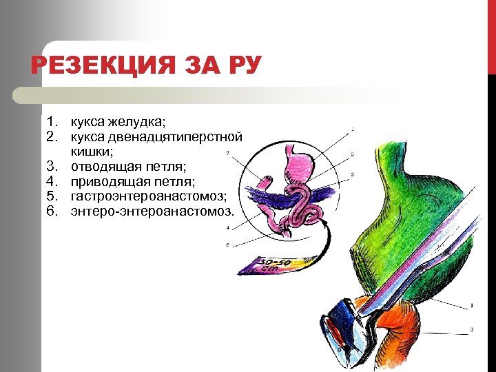 РЕЗЕКЦИЯ ЗА РУ 1. кукса желудка; 2. кукса двенадцятиперстной кишки; 3. отводящая петля; 4.