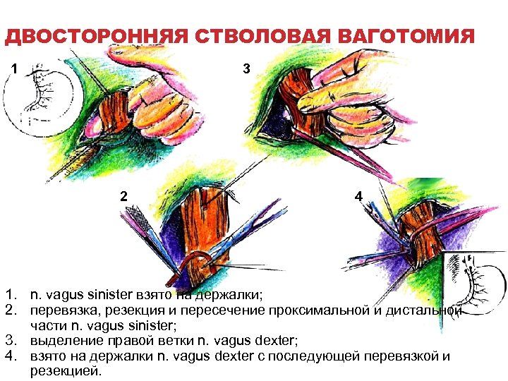 ДВОСТОРОННЯЯ СТВОЛОВАЯ ВАГОТОМИЯ 1 3 2 4 1. n. vagus sinister взято на держалки;