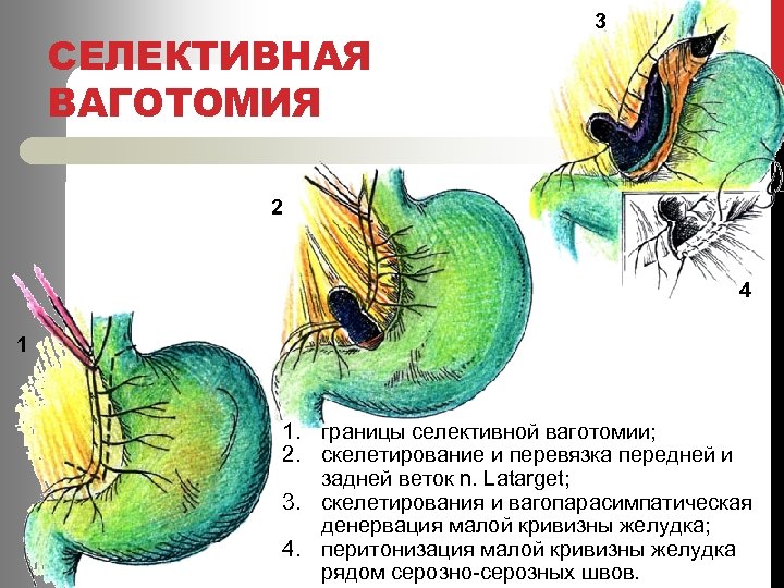 СЕЛЕКТИВНАЯ ВАГОТОМИЯ 3 2 4 1 1. границы селективной ваготомии; 2. скелетирование и перевязка
