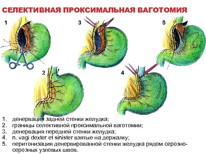СЕЛЕКТИВНАЯ ПРОКСИМАЛЬНАЯ ВАГОТОМИЯ 1 3 2 1. 2. 3. 4. 5. 5 4 денервация