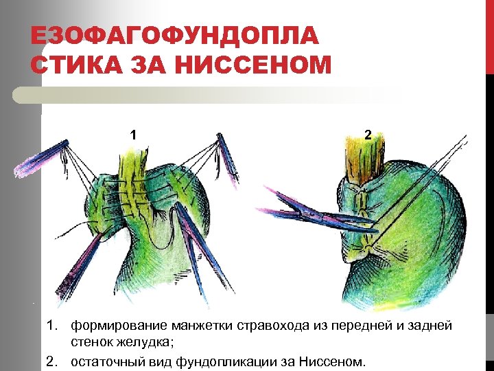 ЕЗОФАГОФУНДОПЛА СТИКА ЗА НИССЕНОМ 1 2 1. формирование манжетки стравохода из передней и задней