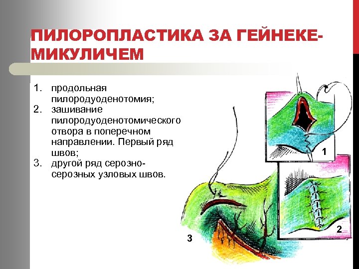 ПИЛОРОПЛАСТИКА ЗА ГЕЙНЕКЕМИКУЛИЧЕМ 1. продольная пилородуоденотомия; 2. зашивание пилородуоденотомического отвора в поперечном направлении. Первый