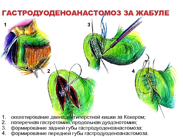 ГАСТРОДУОДЕНОАНАСТОМОЗ ЗА ЖАБУЛЕ 1 3 2 1. 2. 3. 4. 4 скелетирование двенадцятиперстной кишки