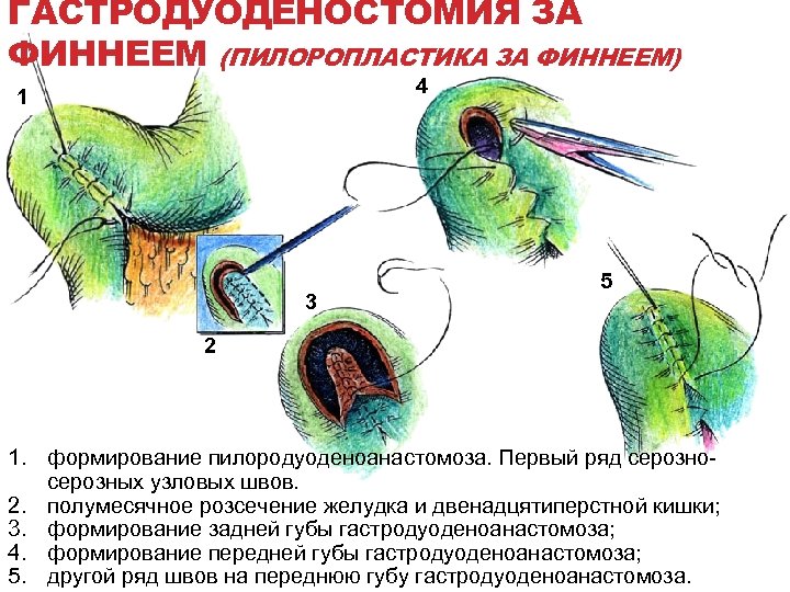 Пилоропластика по финнею схема