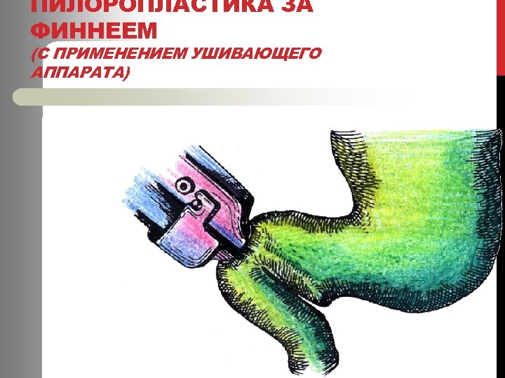 ПИЛОРОПЛАСТИКА ЗА ФИННЕЕМ (С ПРИМЕНЕНИЕМ УШИВАЮЩЕГО АППАРАТА) 