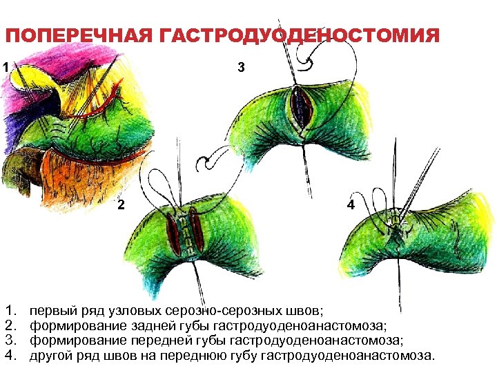 ПОПЕРЕЧНАЯ ГАСТРОДУОДЕНОСТОМИЯ 1 3 2 1. 2. 3. 4. 4 первый ряд узловых серозно-серозных