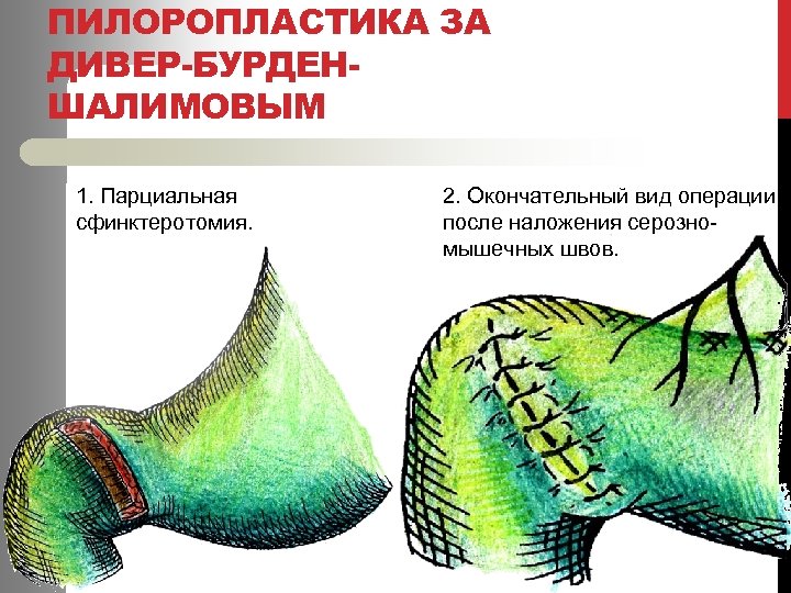 ПИЛОРОПЛАСТИКА ЗА ДИВЕР-БУРДЕНШАЛИМОВЫМ 1. Парциальная сфинктеротомия. 2. Окончательный вид операции после наложения серозномышечных швов.