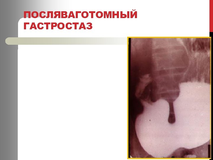 ПОСЛЯВАГОТОМНЫЙ ГАСТРОСТАЗ 