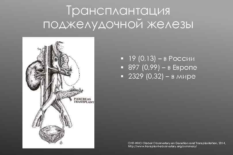 Трансплантация поджелудочной железы § 19 (0, 13) – в России § 897 (0, 99)