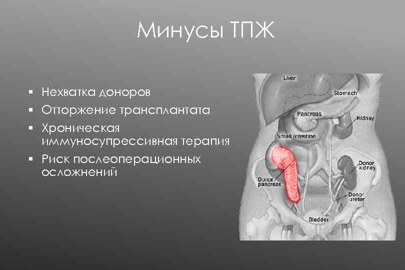 Минусы ТПЖ § Нехватка доноров § Отторжение трансплантата § Хроническая иммуносупрессивная терапия § Риск