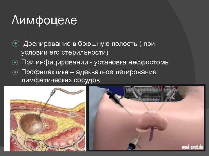 Лимфоцеле ⦿ Дренирование в брюшную полость ( при условии его стерильности) ⦿ При инфицировании