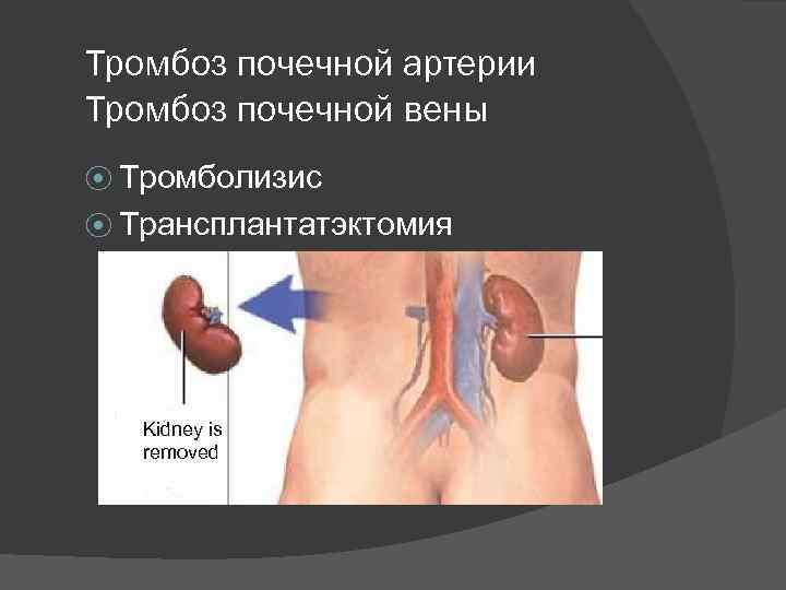 Тромбоз почечной артерии Тромбоз почечной вены ⦿ Тромболизис ⦿ Трансплантатэктомия Kidney is removed 