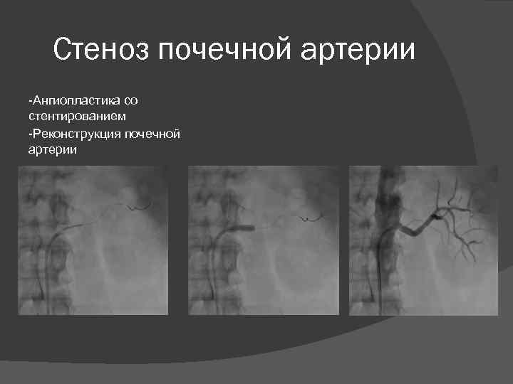 Стеноз почечной артерии -Ангиопластика со стентированием -Реконструкция почечной артерии 